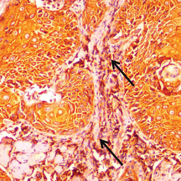 Myxovirus-dayanıklı protein bir (MxA)